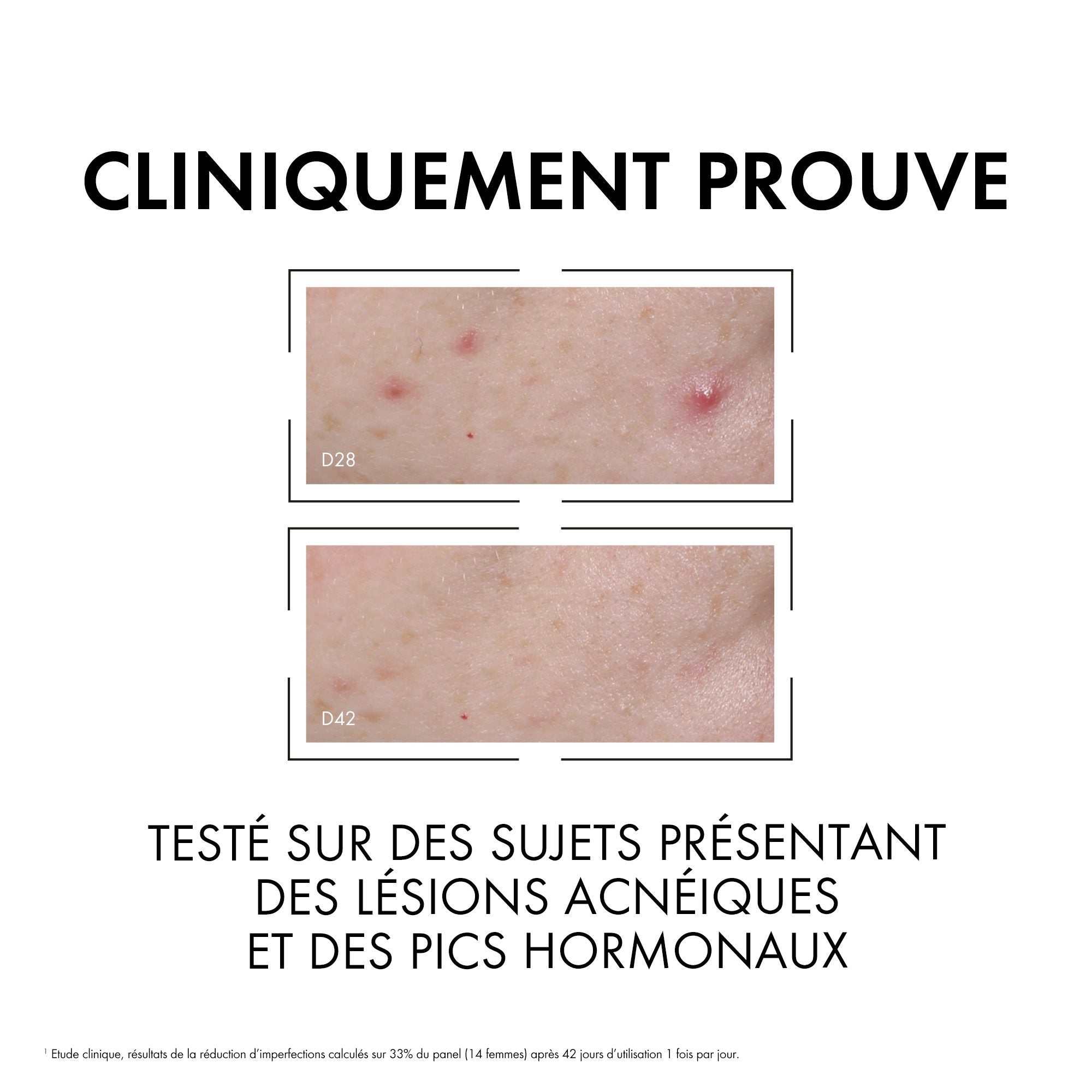Vichy Normaderm Sérum Anti-Imperfections PROBIO-BHA. Peau Grasse Acnéique | 30ml